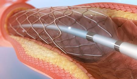  imagem Angioplastia Coronariana