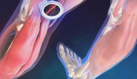  imagem Angioplastia Periférica